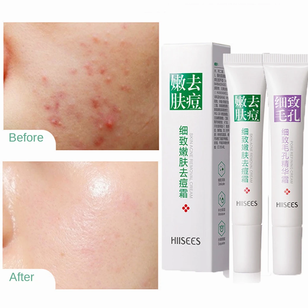 20ml Acne Removal Cream Acne Treatment Oil Control Serum Anti-Acne Shrink Pores Whitening Moisturizing Face Cream Skin Care
20ml Acne Removal Cream Acne Treatment Oil Control Serum Anti-Acne Shrink Pores Whitening Moisturizing Face Cream Skin Care