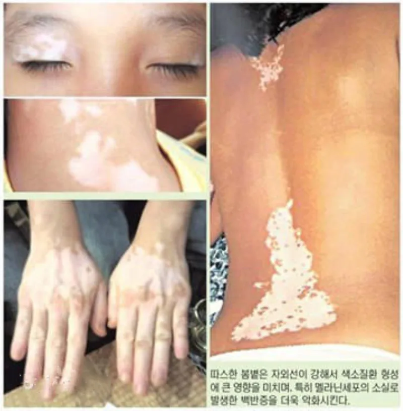 Vitiligo topical melanin repair white spot cover liquid waterproof special effect concealer treatment white epilepsy
Vitiligo topical melanin repair white spot cover liquid waterproof special effect concealer treatment white epilepsy