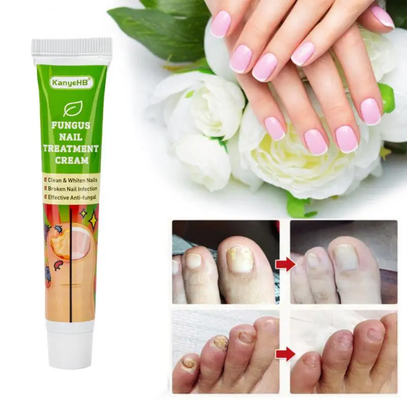KanyeHB Nail Fungal Treatment Feet Care Essence Nail Foot Toe Nail Fungus Removal Gel Anti Infection Paronychia Onychomyco TSLM2
KanyeHB Nail Fungal Treatment Feet Care Essence Nail Foot Toe Nail Fungus Removal Gel Anti Infection Paronychia Onychomyco TSLM2