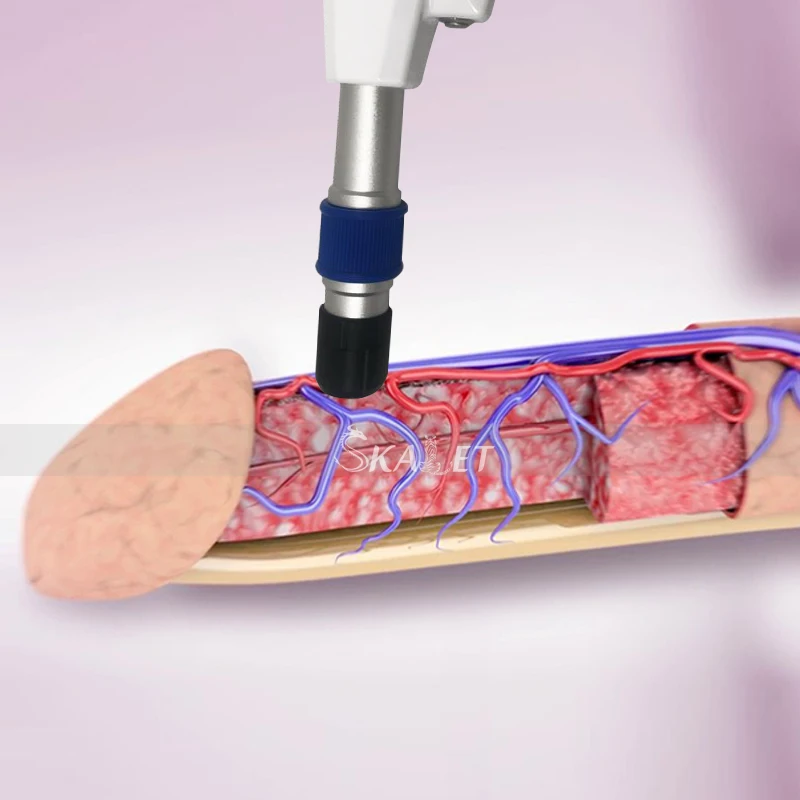 Fast Shipping Pneumatic Extracorporeal Physiotherapy Shockwave Pain Relief Equipment for ED Treatment Body Relaxation 
Fast Shipping Pneumatic Extracorporeal Physiotherapy Shockwave Pain Relief Equipment for ED Treatment Body Relaxation