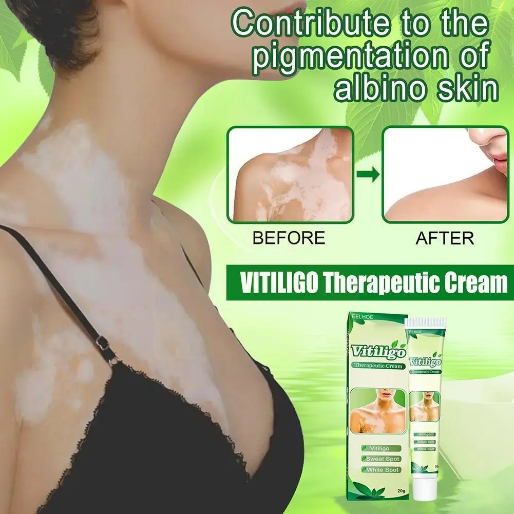 Vitiligo Leukoplakia Disease Treatment Ointment White Pigment Cream Chinese Disease Melanin Medical Cream Body Balm Repair L6N3
Vitiligo Leukoplakia Disease Treatment Ointment White Pigment Cream Chinese Disease Melanin Medical Cream Body Balm Repair L6N3