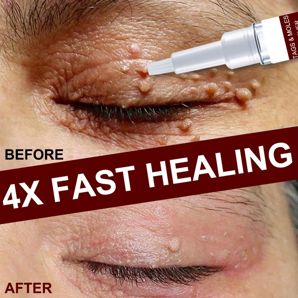 2pcs Skin Wart Removal Liquid 3ml Quickly Remove Male Female Skin Tag Remove Pen Moles Remover
2pcs Skin Wart Removal Liquid 3ml Quickly Remove Male Female Skin Tag Remove Pen Moles Remover