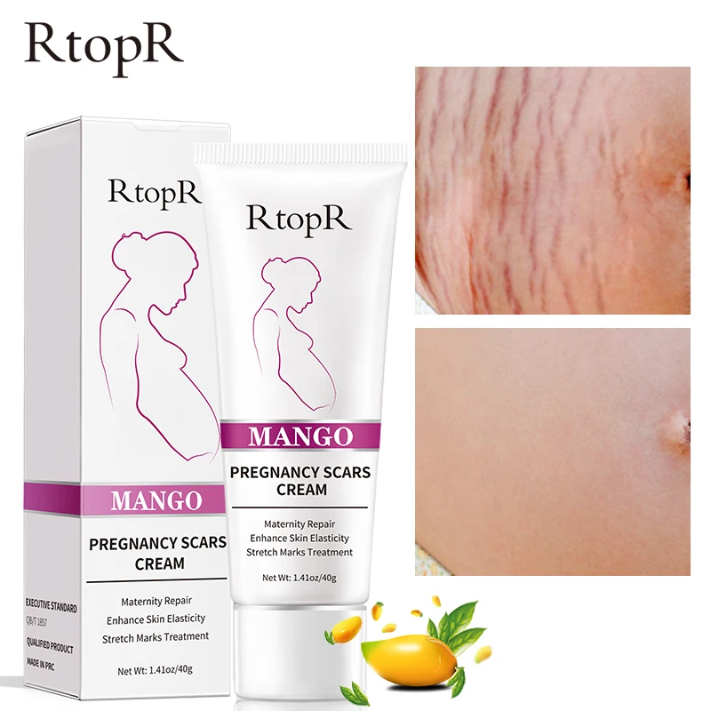 RtopR Mango Stretch Marks Scars Acne Cream Remove Pregnancy Scars Maternity Repair Anti-Aging Anti-Winkles Firming Body Creams
RtopR Mango Stretch Marks Scars Acne Cream Remove Pregnancy Scars Maternity Repair Anti-Aging Anti-Winkles Firming Body Creams