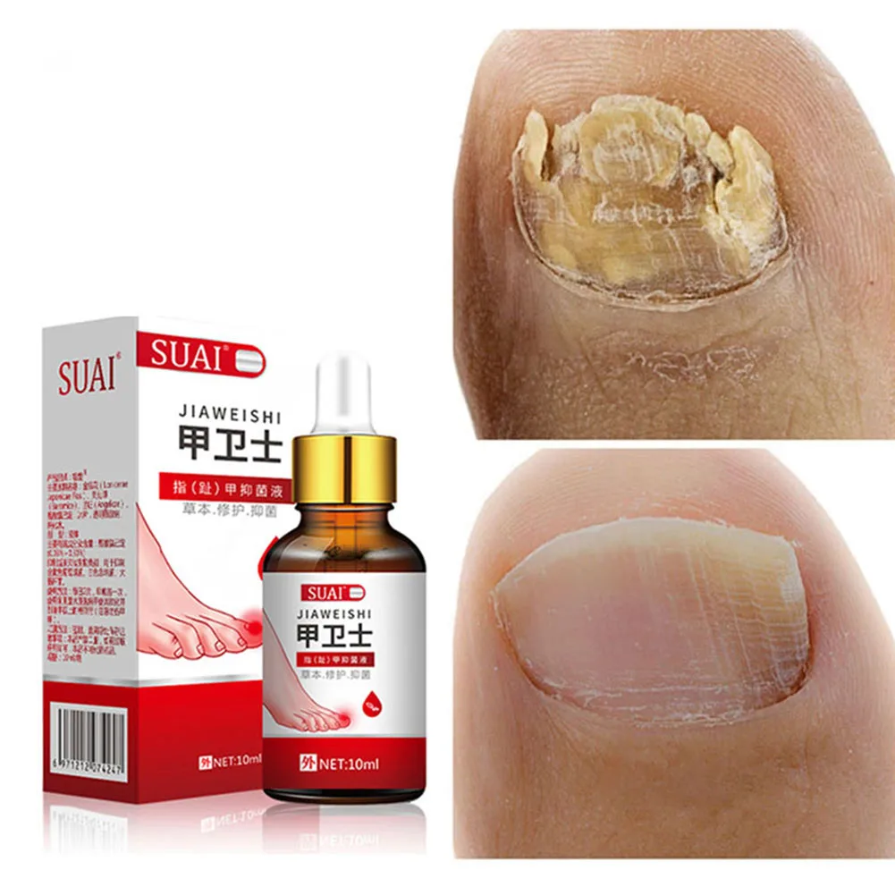 Nail Treatment Essence Anti-Infection Fungus Removal Solution for Paronychia Onychomycosis Nail Care Nail Equipment
Nail Treatment Essence Anti-Infection Fungus Removal Solution for Paronychia Onychomycosis Nail Care Nail Equipment