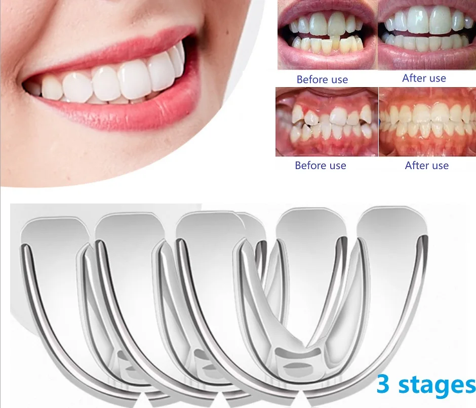 3 Stages Dental Orthodontic Teeth Silicone Braces Appliance Trainer Corrector Alignment Trainer Teeth for Adults Tooth Care Tool
3 Stages Dental Orthodontic Teeth Silicone Braces Appliance Trainer Corrector Alignment Trainer Teeth for Adults Tooth Care Tool