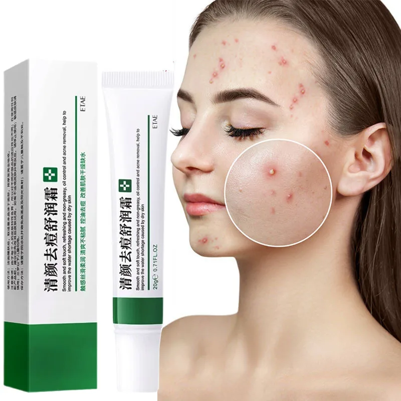 Effective Acne Cream Fades Acne Spots Oil Control Shrinks Pores Whitening Moisturizing Acne Gel Skin Care Skin Whitening Cream
Effective Acne Cream Fades Acne Spots Oil Control Shrinks Pores Whitening Moisturizing Acne Gel Skin Care Skin Whitening Cream