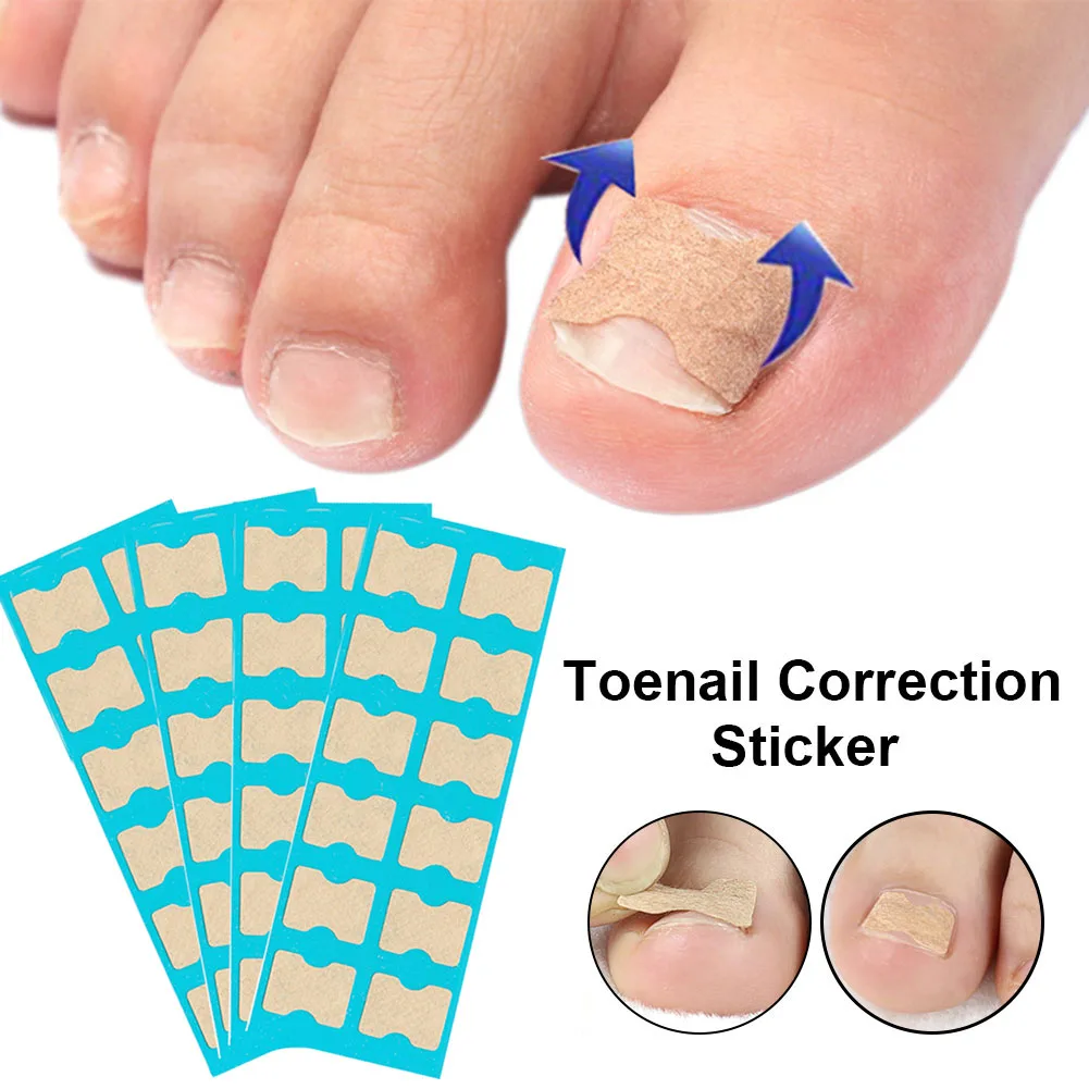 Glue-free Ingrown nail patch Toenail Correction Sticker Professional Adhesive Foot Care Tape Soothing and Convenient for all
Glue-free Ingrown nail patch Toenail Correction Sticker Professional Adhesive Foot Care Tape Soothing and Convenient for all