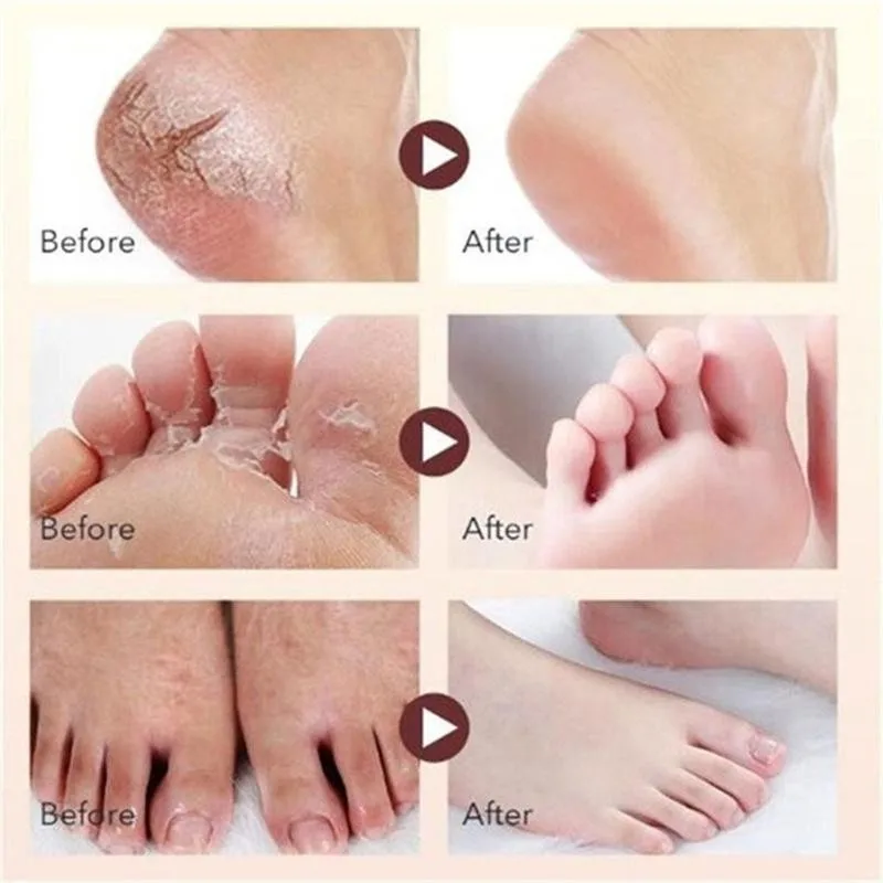 15g/30g/50g Cracked Hand And Foot Cream Cracked Hands And Feet Cream, Foot Bubble Peeling, Scar And Rotten Feet Cream
15g/30g/50g Cracked Hand And Foot Cream Cracked Hands And Feet Cream, Foot Bubble Peeling, Scar And Rotten Feet Cream
