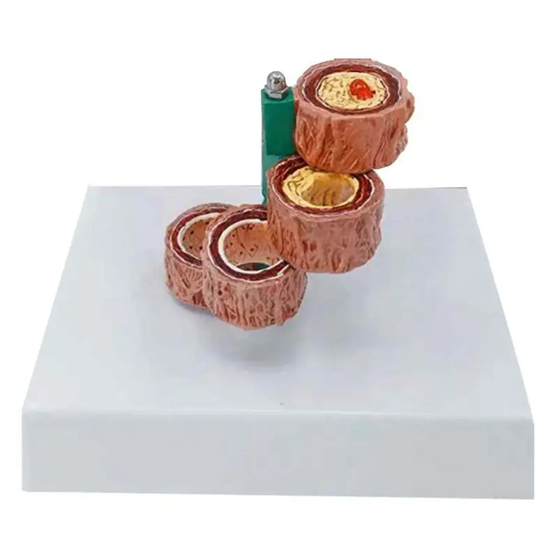 Blood Vessel human Hardening Of The Arteries Arteriosclerosis Model human Anatomical anatomy Model Medical supplies tools
Blood Vessel human Hardening Of The Arteries Arteriosclerosis Model human Anatomical anatomy Model Medical supplies tools