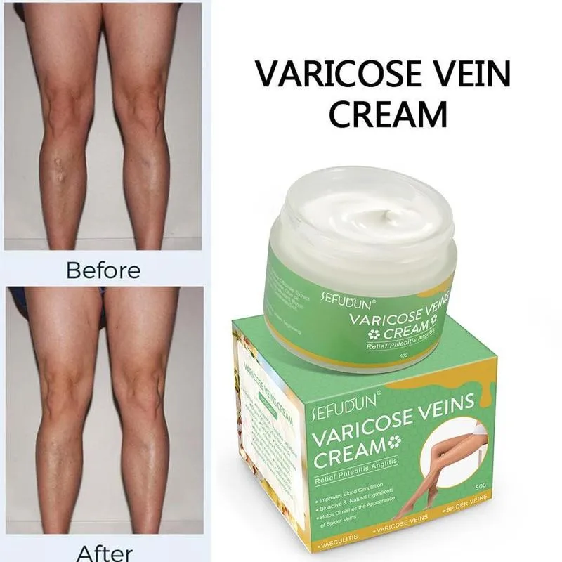 50g Varicose Veins Treatment Cream Varicosity Angiitis Remedy Ointment Relief Veins Pain Phlebitis legs Varicose Veins Cream
50g Varicose Veins Treatment Cream Varicosity Angiitis Remedy Ointment Relief Veins Pain Phlebitis legs Varicose Veins Cream