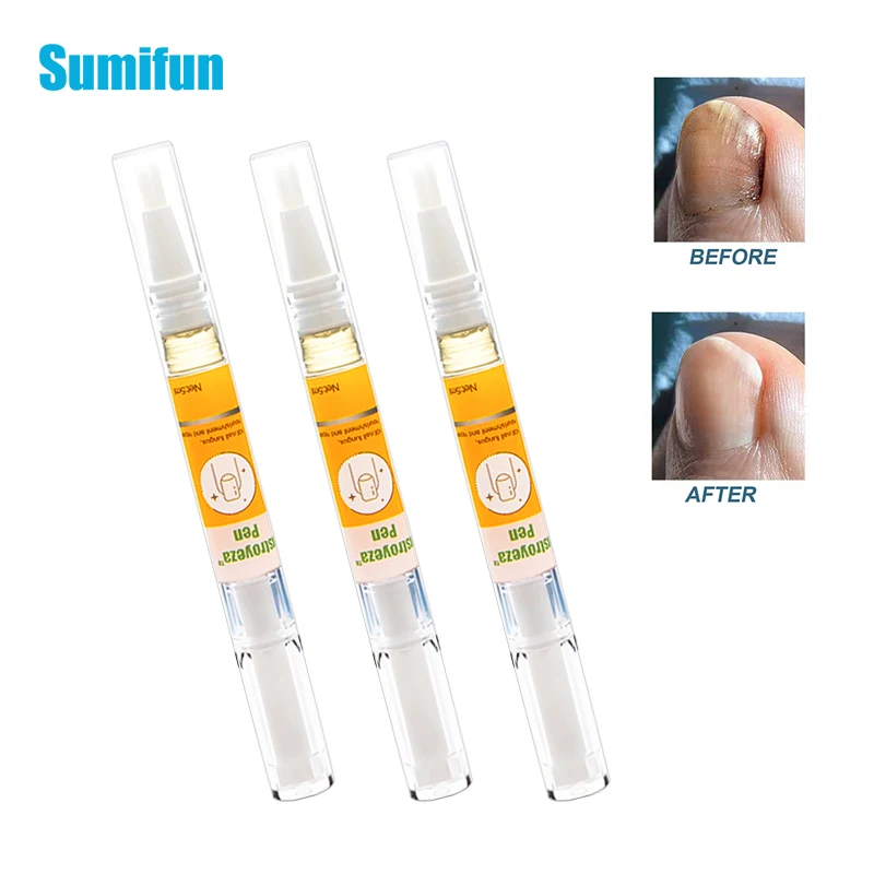 1 шт., антибактериальная мазь для удаления грибков на ногтях 
1 шт., антибактериальная мазь для удаления грибков на ногтях