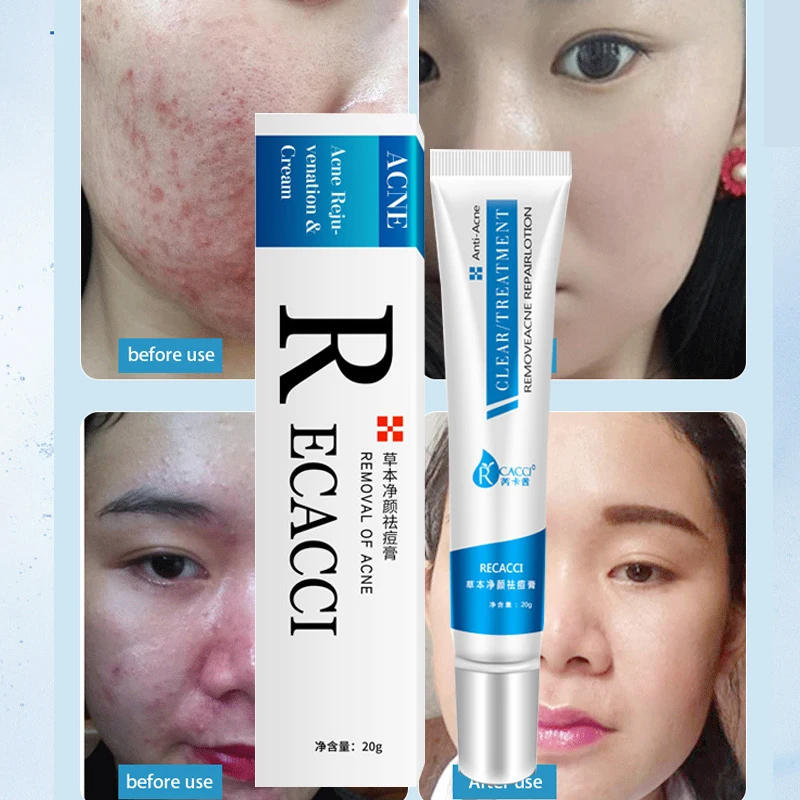Anti-acne ointment oil control shrink pores acne scars moisturizing deep repair removal facial skin care facial care ointment
Anti-acne ointment oil control shrink pores acne scars moisturizing deep repair removal facial skin care facial care ointment