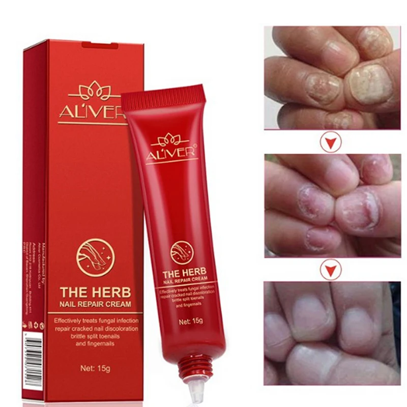Nail Fungus Treatment Nail Cream Anti Fungal Nail Cuticle Remover Liquid Nail Growth Skin Care
Nail Fungus Treatment Nail Cream Anti Fungal Nail Cuticle Remover Liquid Nail Growth Skin Care