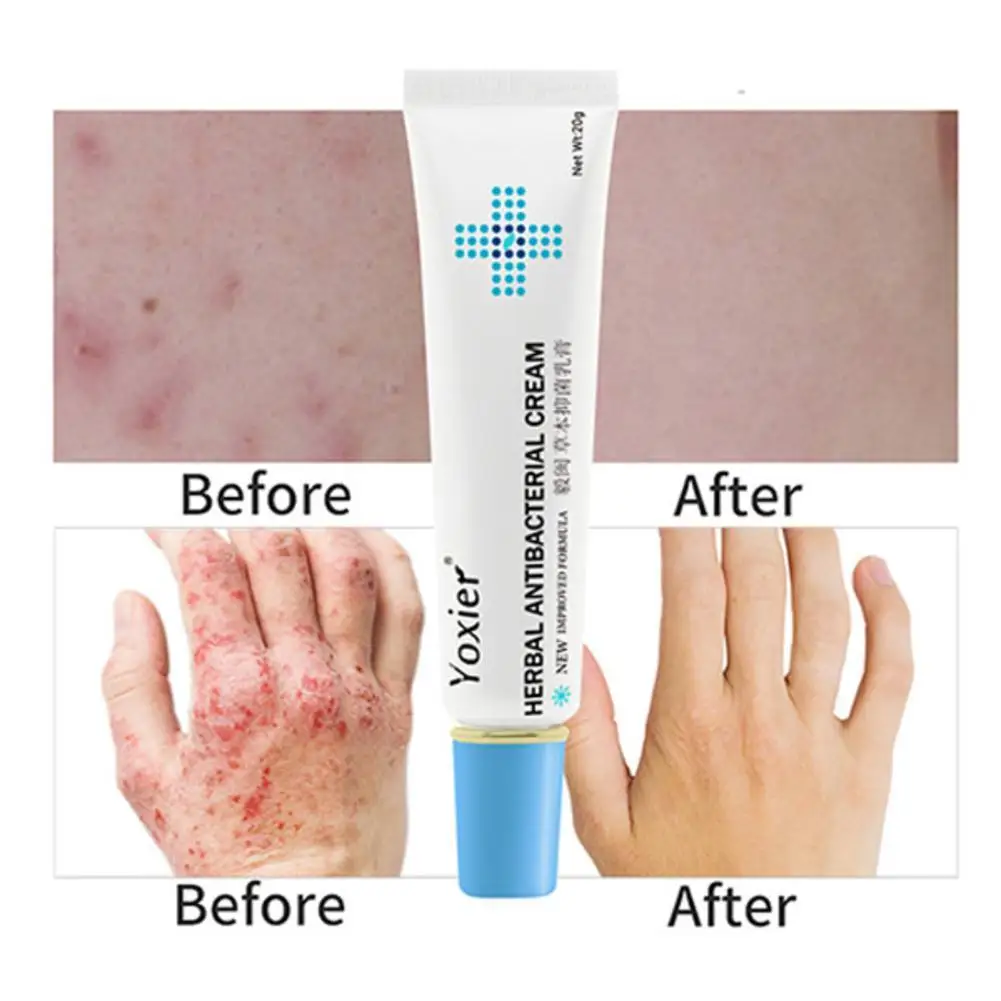 Herbal Antibacterial Cream Psoriasis Cream Anti-itch Relief Eczema Skin Rash Urticaria Desquamation Treatment 20G
Herbal Antibacterial Cream Psoriasis Cream Anti-itch Relief Eczema Skin Rash Urticaria Desquamation Treatment 20G