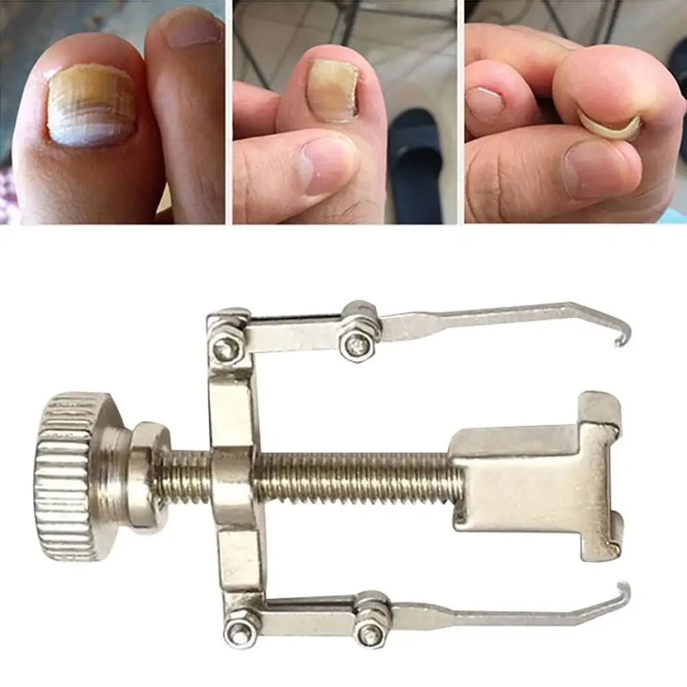 

Ingrown Toenail Toe Fixer Recover Correction Device Pedicure Foot Nail Care Tool Straightening Clip Brace corrector Wire Fixer