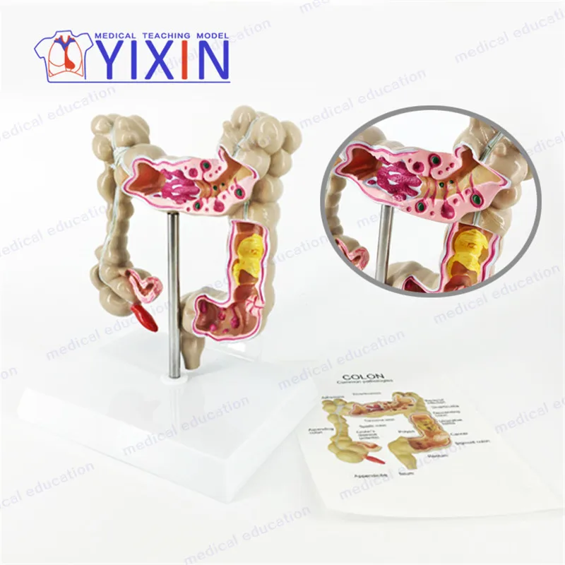 Колоректальный модель поражения человеческий инструмент для обучения патологической анатомии, заболеваний толстой кишки, пищеварительно...
Колоректальный модель поражения человеческий инструмент для обучения патологической анатомии, заболеваний толстой кишки, пищеварительно...