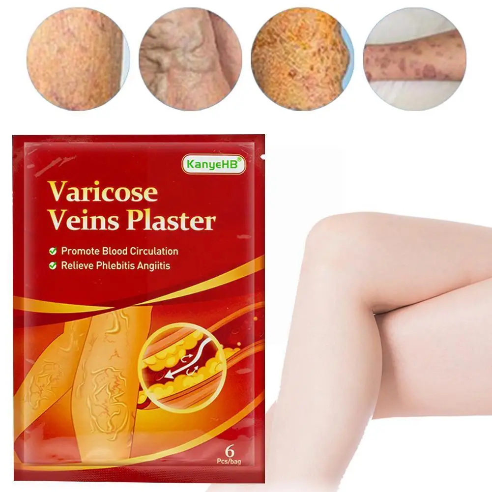 Varicose Veins Ointment Vasculitis Phlebitis Spider Plaster Angiitis Tissue Soft Plaster Medical Cream Treat Varicosity Swe V4P8
Varicose Veins Ointment Vasculitis Phlebitis Spider Plaster Angiitis Tissue Soft Plaster Medical Cream Treat Varicosity Swe V4P8