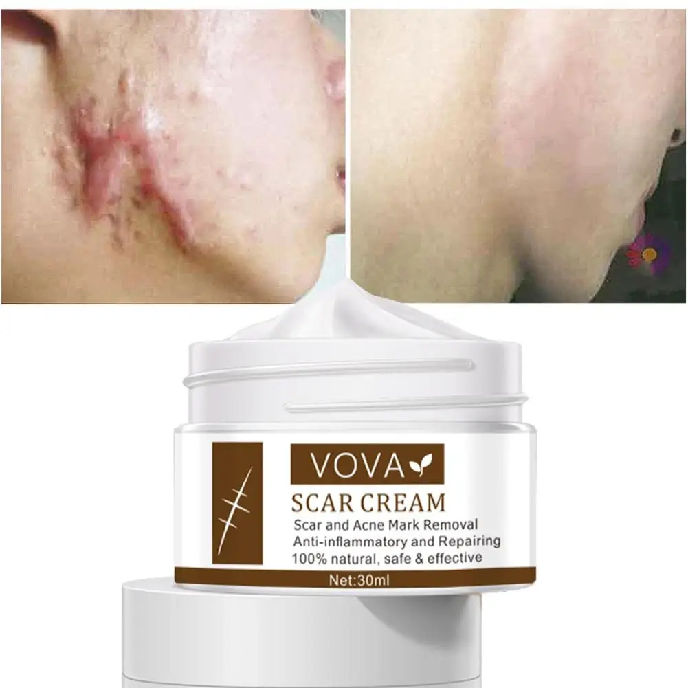 30g Acne Scar Removal Creams Pimples Stretch Marks Face Gel Remove Acne Smoothing Whitening Moisturizing Body Skin Care Aichun
30g Acne Scar Removal Creams Pimples Stretch Marks Face Gel Remove Acne Smoothing Whitening Moisturizing Body Skin Care Aichun