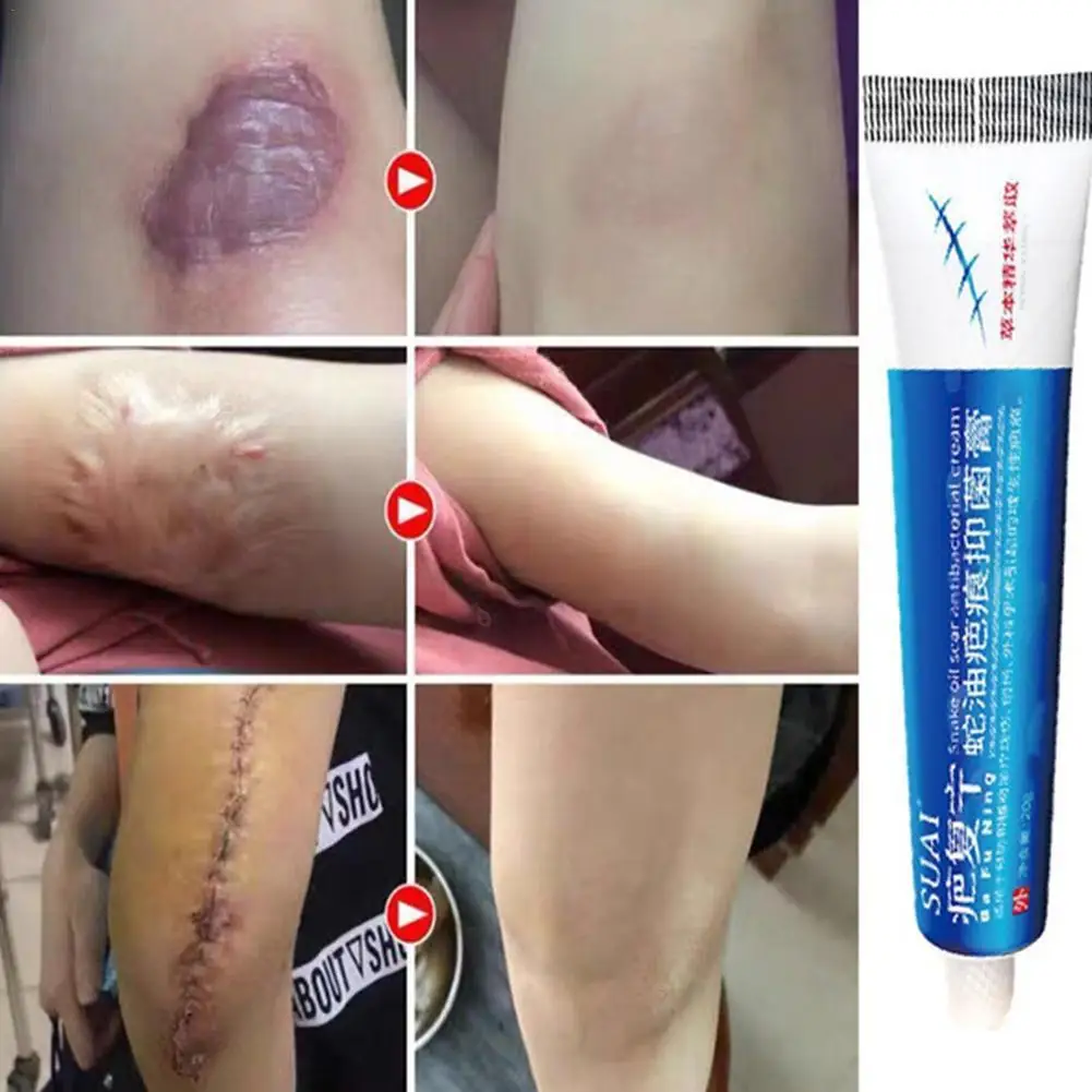 20g Scars Removal Repair Cream Scald Burn Papules Eczema Ointment Relieves Skin Itching Psoriasis Derma Treatment Body Skin Care
20g Scars Removal Repair Cream Scald Burn Papules Eczema Ointment Relieves Skin Itching Psoriasis Derma Treatment Body Skin Care