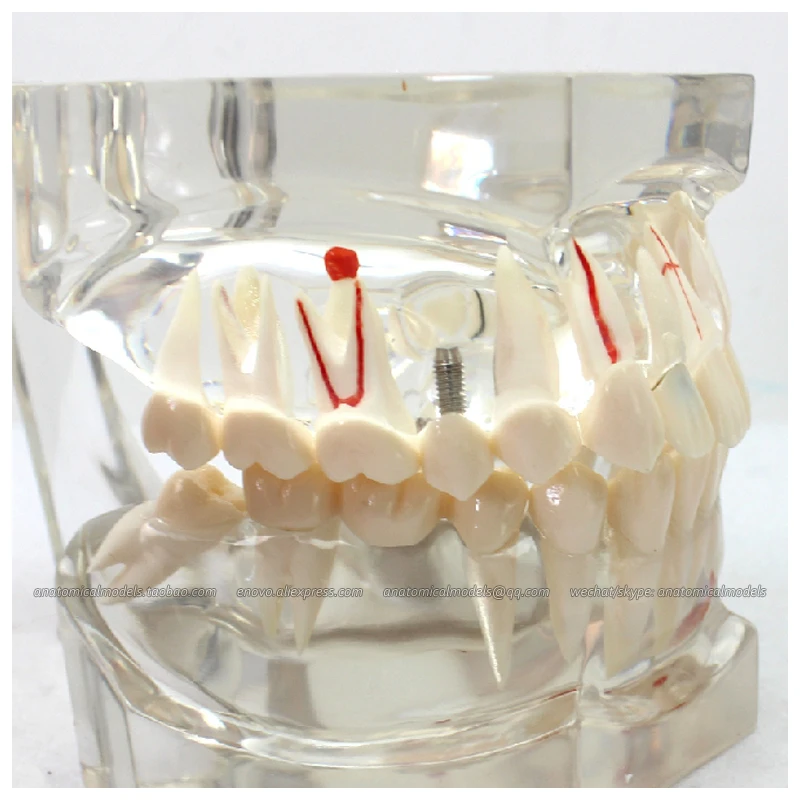 12594 / Transparent 2x Life Size Disease Dental Study Model, Medical Science Educational Teaching Anatomical Models
12594 / Transparent 2x Life Size Disease Dental Study Model, Medical Science Educational Teaching Anatomical Models