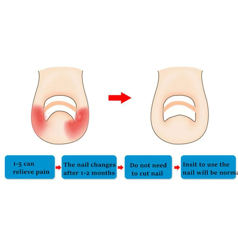 Ingrown Toe Nail Correction Sticker Patch Paronychia Correction File Acronyx Wire Corrector Foot Care Treatment 10pcs/pack
Ingrown Toe Nail Correction Sticker Patch Paronychia Correction File Acronyx Wire Corrector Foot Care Treatment 10pcs/pack