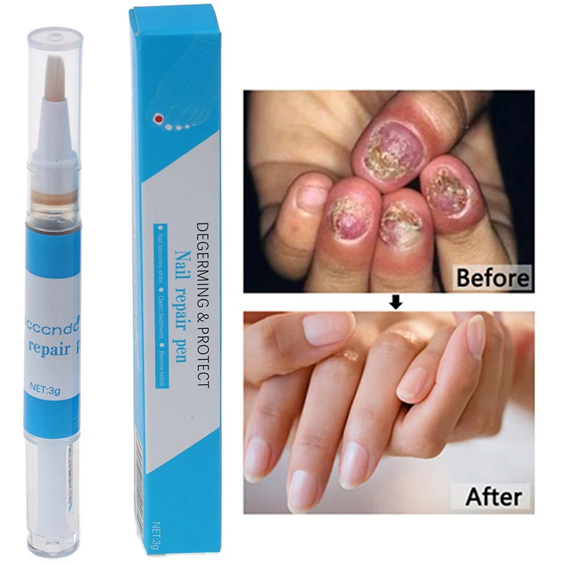 Toenail Fungus Treatment Pen Onychomycosis Paronychia Anti Fungal Chinese Herbal Toe Nail Fungus Treatment
Toenail Fungus Treatment Pen Onychomycosis Paronychia Anti Fungal Chinese Herbal Toe Nail Fungus Treatment