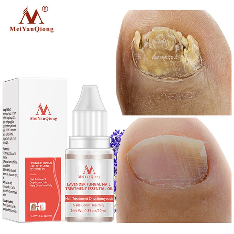 Fungus Nail Treatment Serum Onychomycosis Paronychia Anti-Fungal Nails Infection Herbal Toe Fungus Repair Essence Foot Care 10ml
Fungus Nail Treatment Serum Onychomycosis Paronychia Anti-Fungal Nails Infection Herbal Toe Fungus Repair Essence Foot Care 10ml