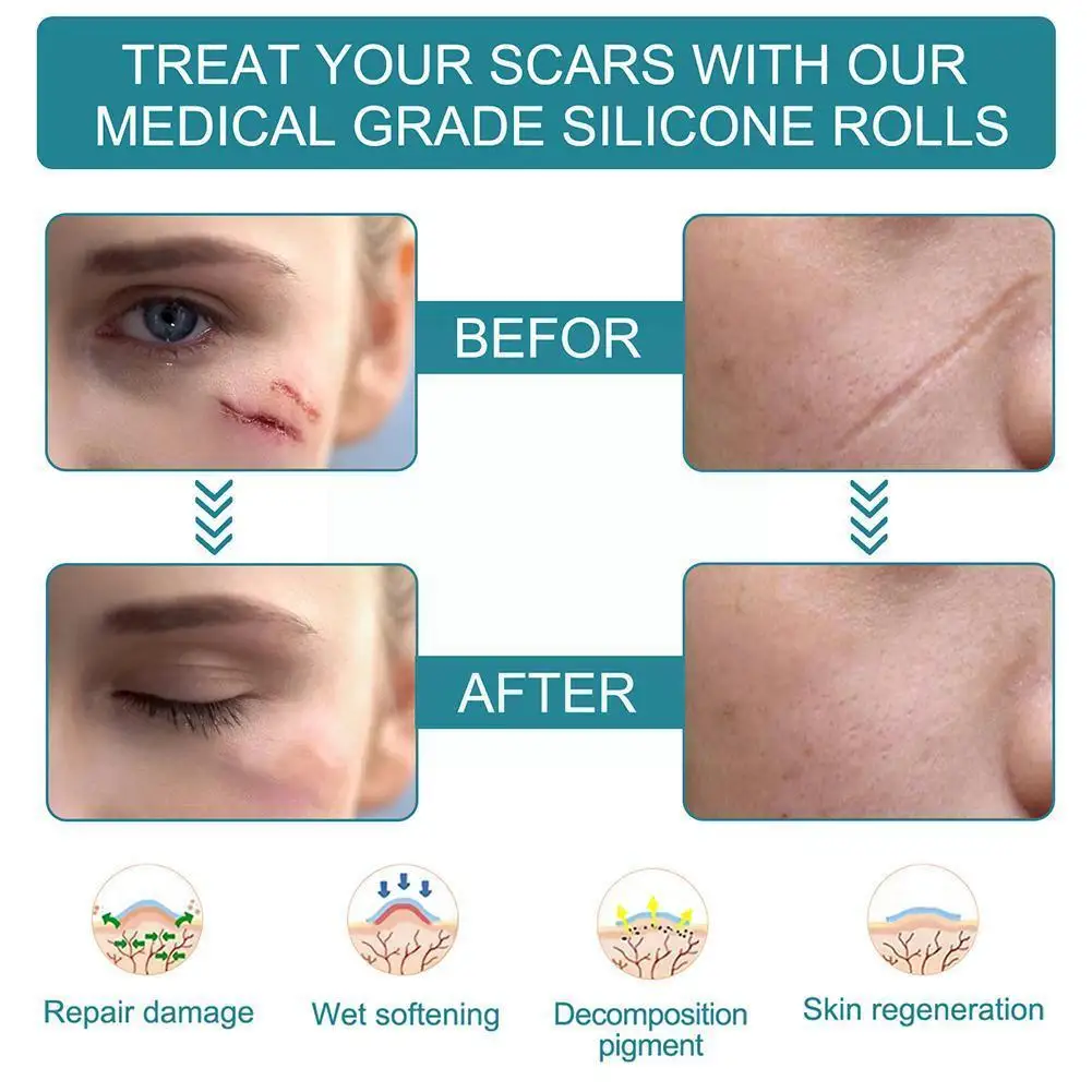 Scar Silicone Sticker Scar Removal Sticker Sheet Patch Silicone Gel Scars Treatment Silicone Gel Tape Patch For Acne Burn S G4c7
Scar Silicone Sticker Scar Removal Sticker Sheet Patch Silicone Gel Scars Treatment Silicone Gel Tape Patch For Acne Burn S G4c7