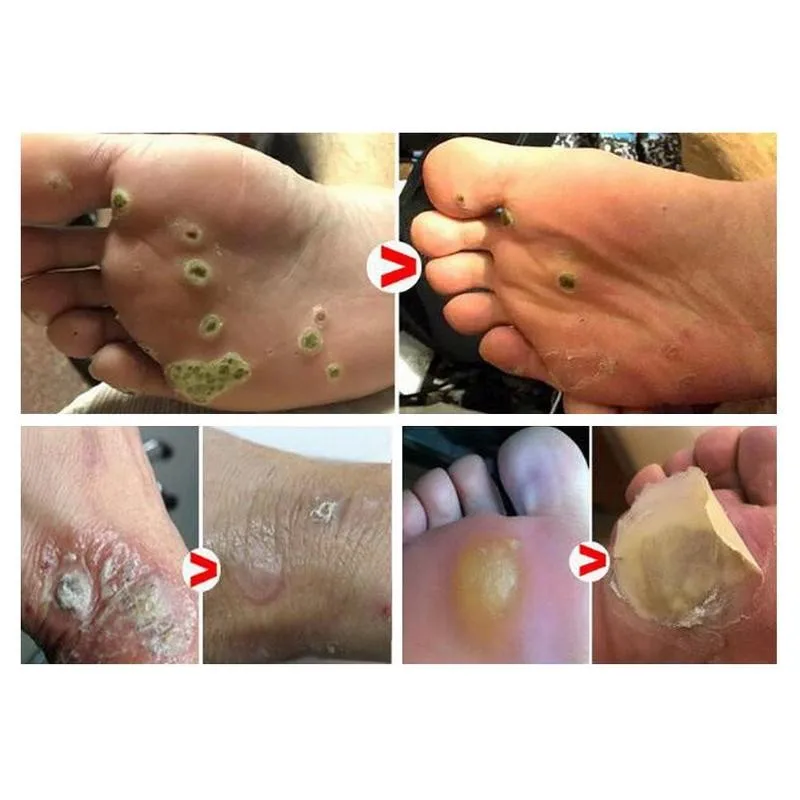 Body Warts Treatment Cream Skin Tag Remover Wart Corn Patch Remover Light Corns Wart Care Flat 3ml Foot Net Cream Foot R9F4
Body Warts Treatment Cream Skin Tag Remover Wart Corn Patch Remover Light Corns Wart Care Flat 3ml Foot Net Cream Foot R9F4