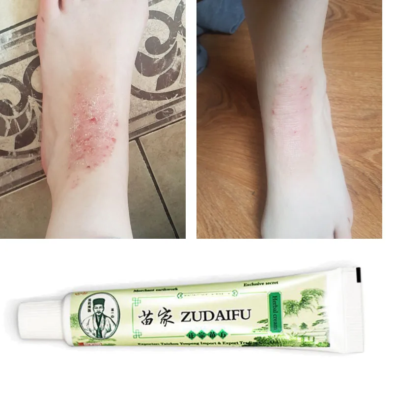 

Натуральный китайский травяной крем для кожи при псориазе дерматите экземе мазь для лечения псориаза крем для ухода за кожей