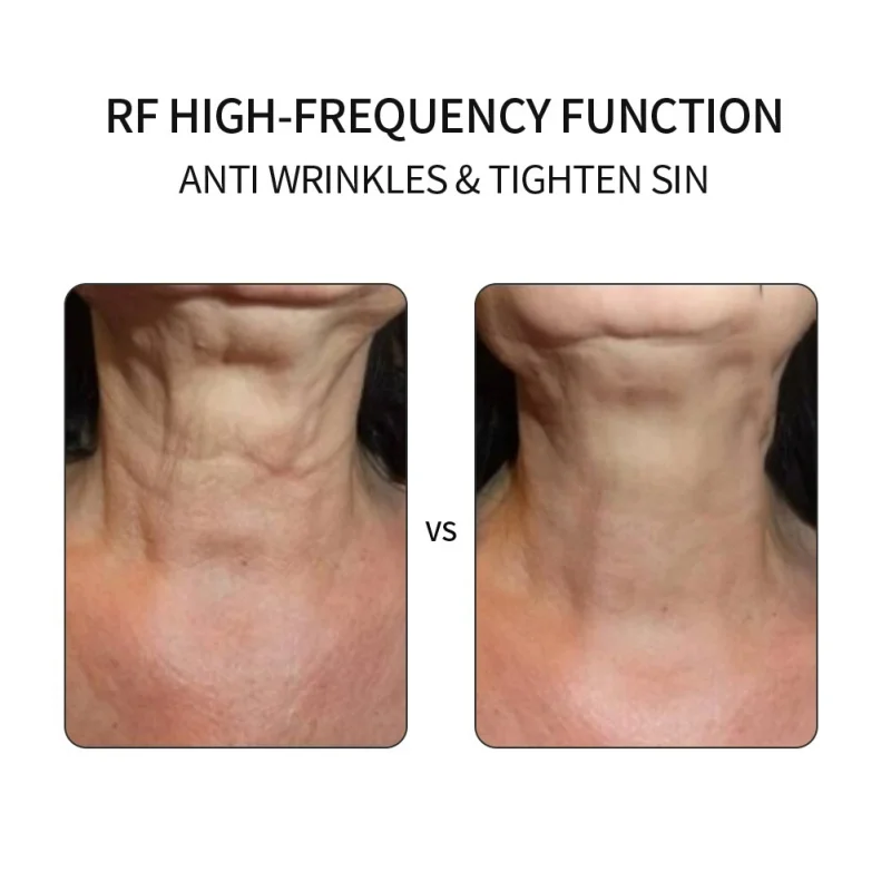 Face Skin Electroporation RF Radio Frequency Facial LED Photon Skin Care Device Face Lift Tighten Beauty Machine NEW
Face Skin Electroporation RF Radio Frequency Facial LED Photon Skin Care Device Face Lift Tighten Beauty Machine NEW