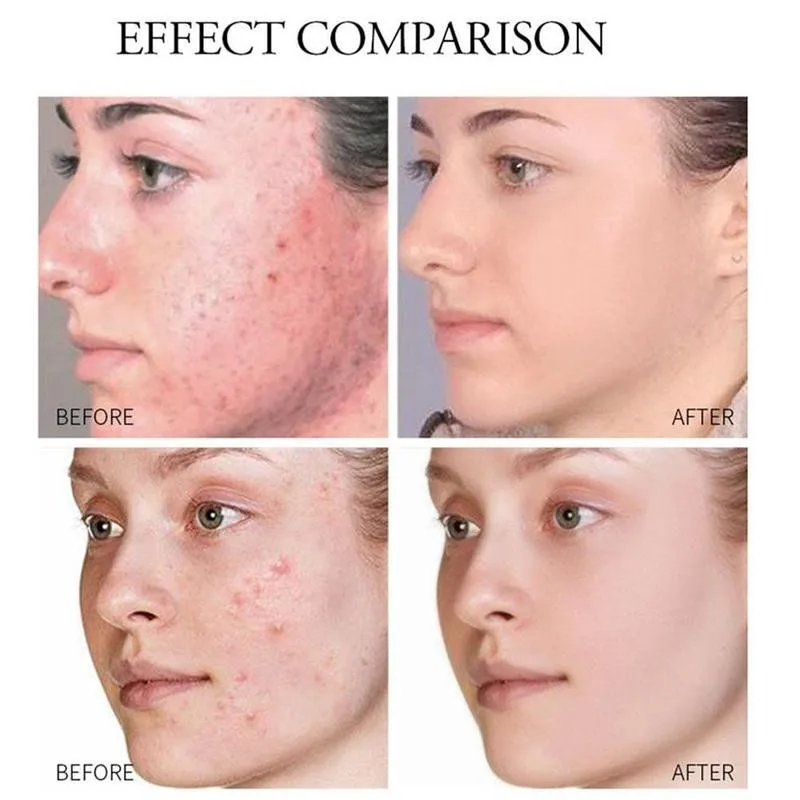 20g Natural Herbal Acne Cream To Acne Acne Marks, Blackheads Acne Acne Repair And Moisturizing Cream And Whitening G6G7
20g Natural Herbal Acne Cream To Acne Acne Marks, Blackheads Acne Acne Repair And Moisturizing Cream And Whitening G6G7