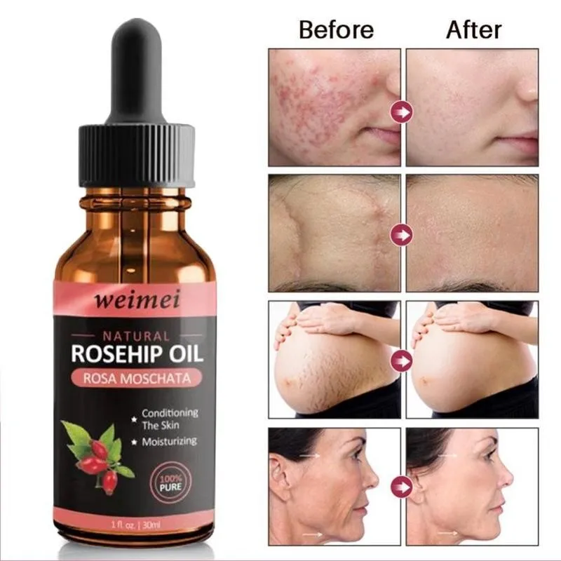 30ml Organic Rosehip Essential Oil Brighten Skin Deeply Moisturizing Face Care Anti-aging Essential Oil 
30ml Organic Rosehip Essential Oil Brighten Skin Deeply Moisturizing Face Care Anti-aging Essential Oil