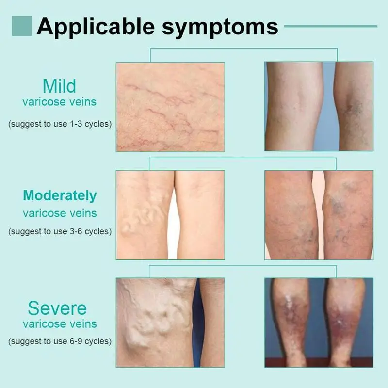 Varicose Veins Cream of Varicose Veins Medical Spider Treatment Chinese Medicine Varicose Veins Ointment 20G
Varicose Veins Cream of Varicose Veins Medical Spider Treatment Chinese Medicine Varicose Veins Ointment 20G