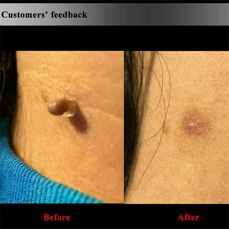 Skin Tag Remove Patch Set Face Wart Removal Patch for Small to Medium Skin Tag Removal Tool Set Green
Skin Tag Remove Patch Set Face Wart Removal Patch for Small to Medium Skin Tag Removal Tool Set Green