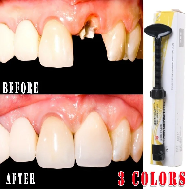Dental A1 2 3 Tree Resin Universal Radiopaque Oral Care Restorative Shade Low Shrinkage Micro Hybrid Composite Light Cured
Dental A1 2 3 Tree Resin Universal Radiopaque Oral Care Restorative Shade Low Shrinkage Micro Hybrid Composite Light Cured