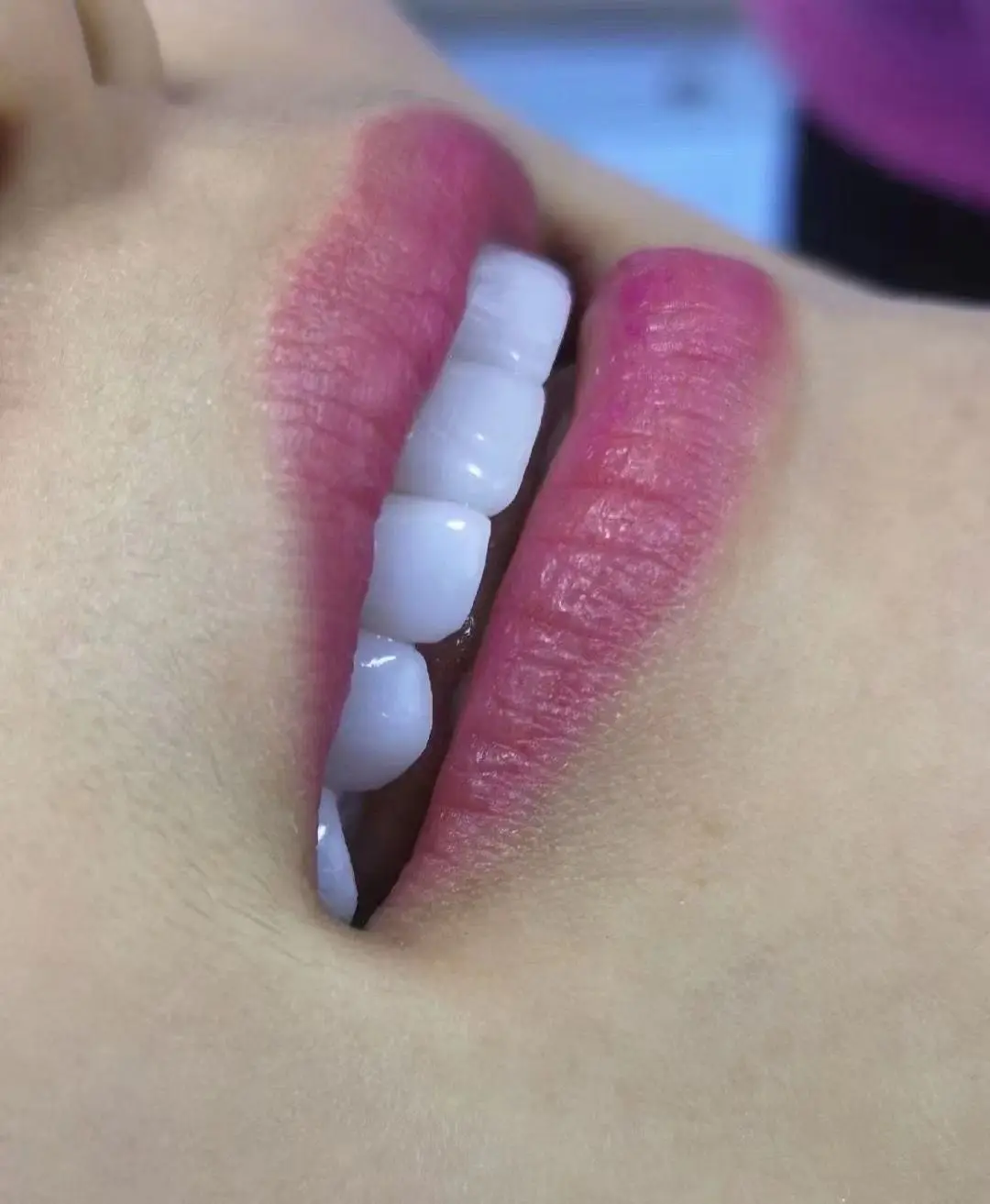 Teeth Veneer Tooth Whitening Dental Porcelain Beauty Salon Thin Ivolcar (UpperTeeth L M S,3 Pieces)(Lower M S,2pieces)
Teeth Veneer Tooth Whitening Dental Porcelain Beauty Salon Thin Ivolcar (UpperTeeth L M S,3 Pieces)(Lower M S,2pieces)