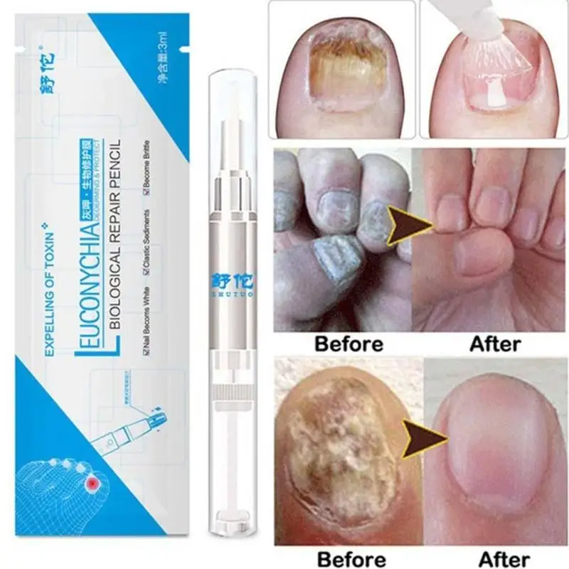 Nail care pen, nail care solution, anti-fungal nail repair solution, anti-fungal nail solution, nail care tool TSLM1
Nail care pen, nail care solution, anti-fungal nail repair solution, anti-fungal nail solution, nail care tool TSLM1