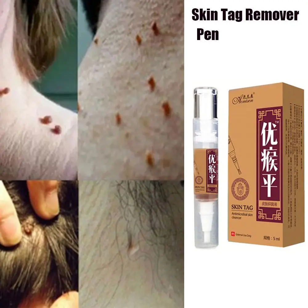 Treatment External Medical Plaster Ointment Mole Warts Removal Foot Corn Herbal Extracts Formula Skin Tag Remover
Treatment External Medical Plaster Ointment Mole Warts Removal Foot Corn Herbal Extracts Formula Skin Tag Remover