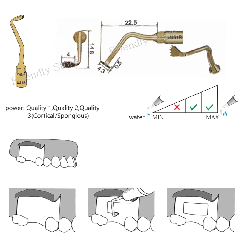 Right Angle US1R Ultrasurgery Tip For MECTRON And WOODPECKER Piezosurgery Equipment Tools Cut Bones In Hard-To-reach Positions
Right Angle US1R Ultrasurgery Tip For MECTRON And WOODPECKER Piezosurgery Equipment Tools Cut Bones In Hard-To-reach Positions
