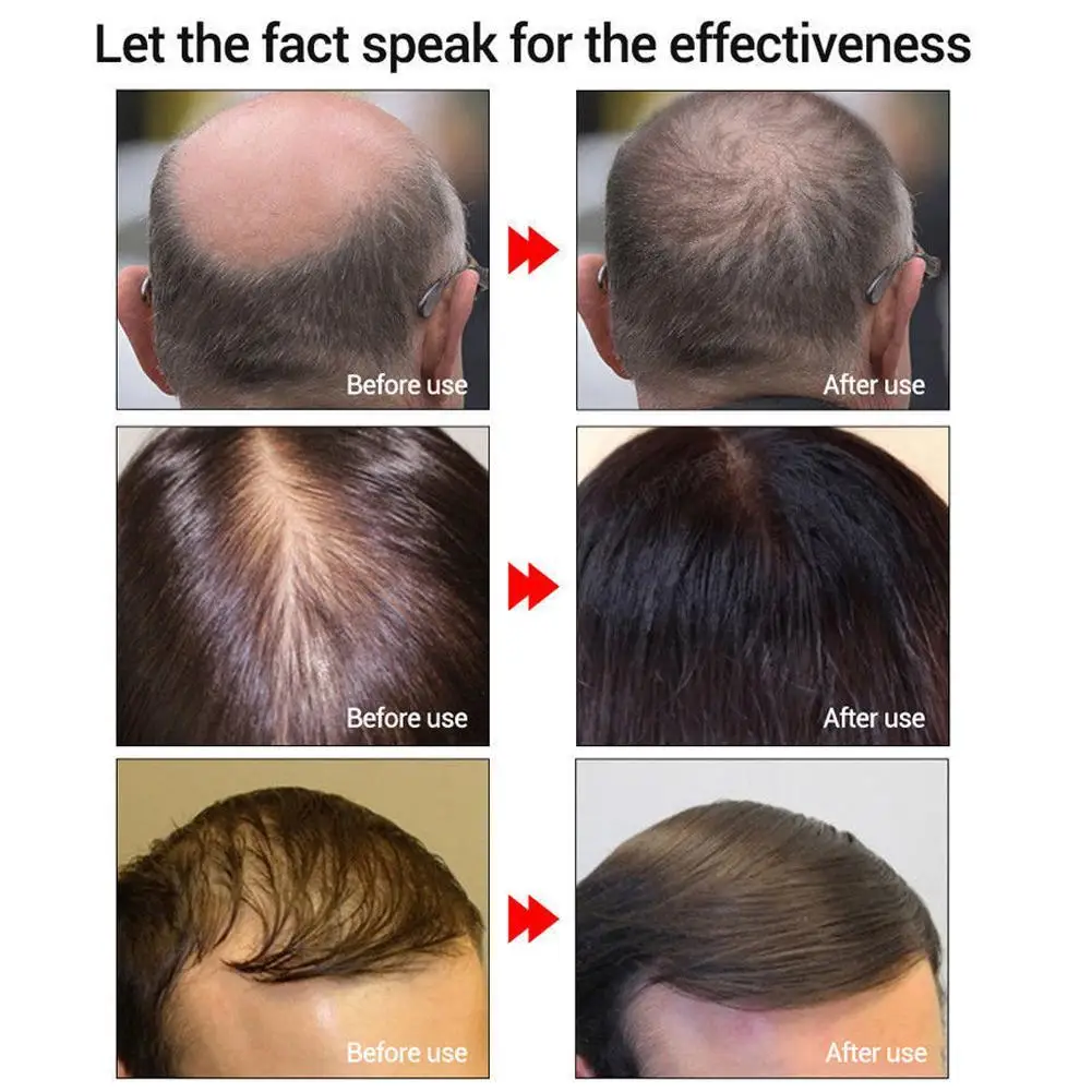 Hair Care Hair Growth Essential Oils Essence Original Authentic 100% Hair Loss Liquid Health Care Beauty Dense Hair Growth Serum
Hair Care Hair Growth Essential Oils Essence Original Authentic 100% Hair Loss Liquid Health Care Beauty Dense Hair Growth Serum
