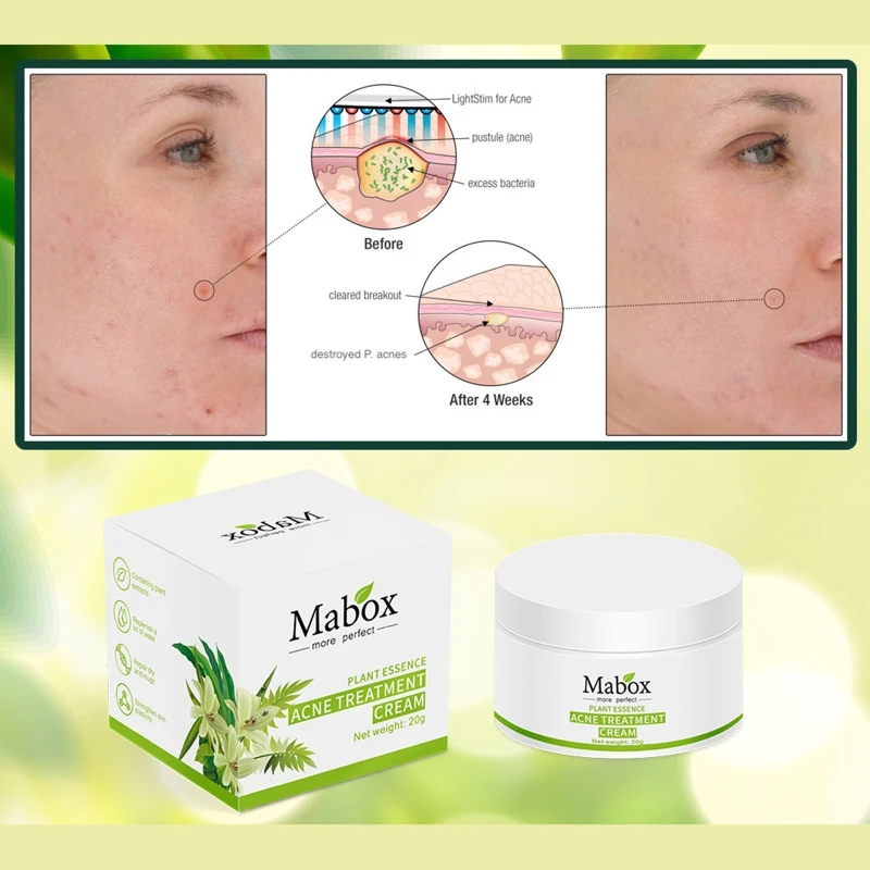 30g Acne Treatment Blackhead Removal Anti-acne Cream Oil Control Shrink Pores U2JD
30g Acne Treatment Blackhead Removal Anti-acne Cream Oil Control Shrink Pores U2JD