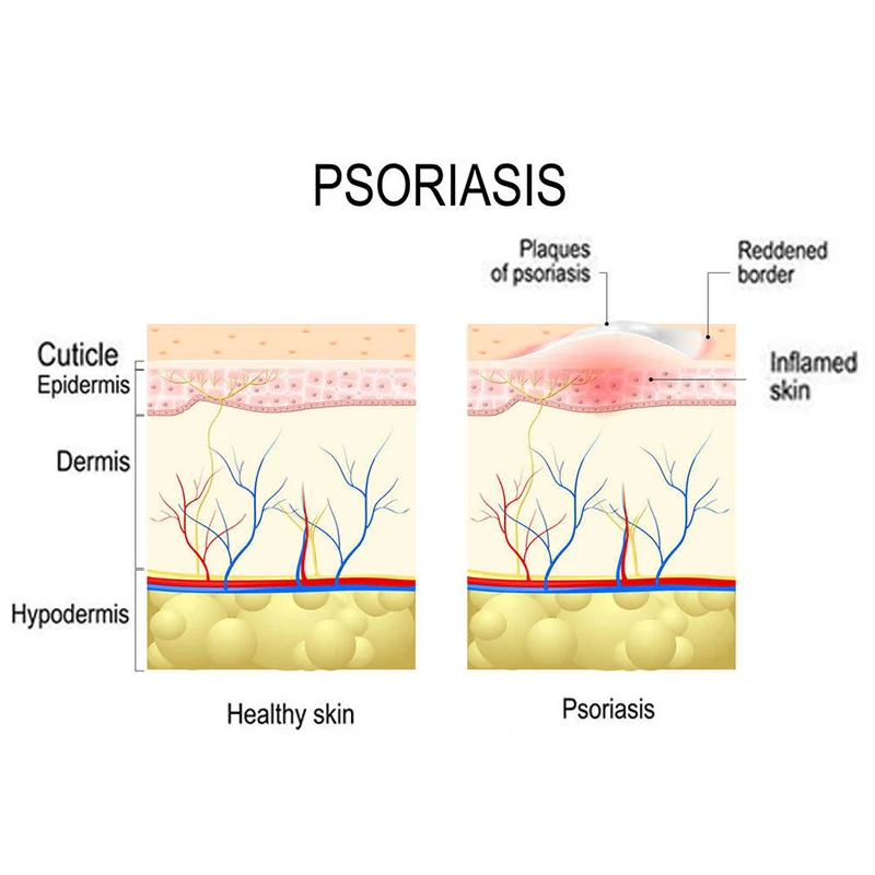 1pcs Cure Psoriasis Cream Skin Care Cream Ringworm Cream Dermatitis Tinea Eczematoid Eczema Ointment Natural Herbal Ointment
1pcs Cure Psoriasis Cream Skin Care Cream Ringworm Cream Dermatitis Tinea Eczematoid Eczema Ointment Natural Herbal Ointment
