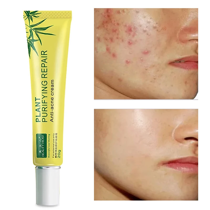 Acne Cream Oil Control Reduce Acne Marks Moisturizing Antipruritic Refreshing Brighten Repair Shrink Pores Face Skin Care 20g
Acne Cream Oil Control Reduce Acne Marks Moisturizing Antipruritic Refreshing Brighten Repair Shrink Pores Face Skin Care 20g