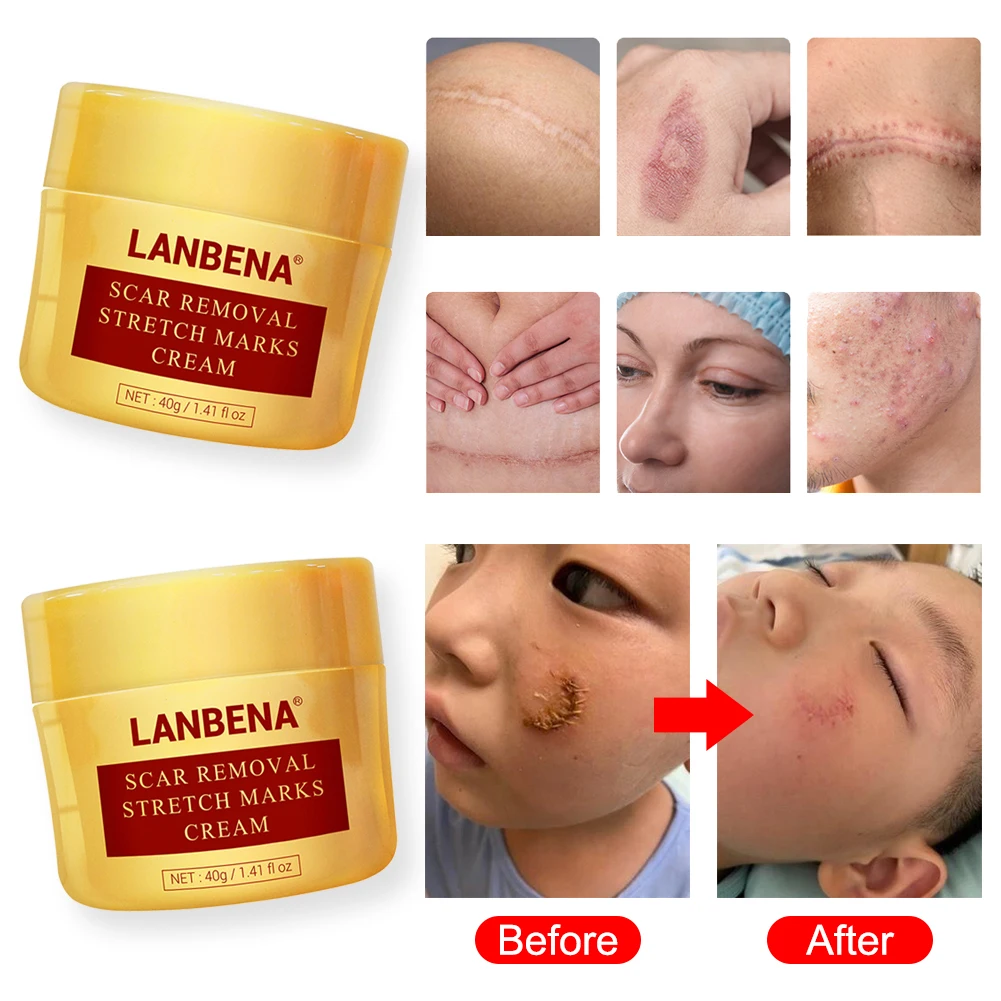 Herbal Scar Cream For Face Body Stretch Mark Acne Marks Scar Removal Cream For Skin With Scar And Papula Scar Cream
Herbal Scar Cream For Face Body Stretch Mark Acne Marks Scar Removal Cream For Skin With Scar And Papula Scar Cream