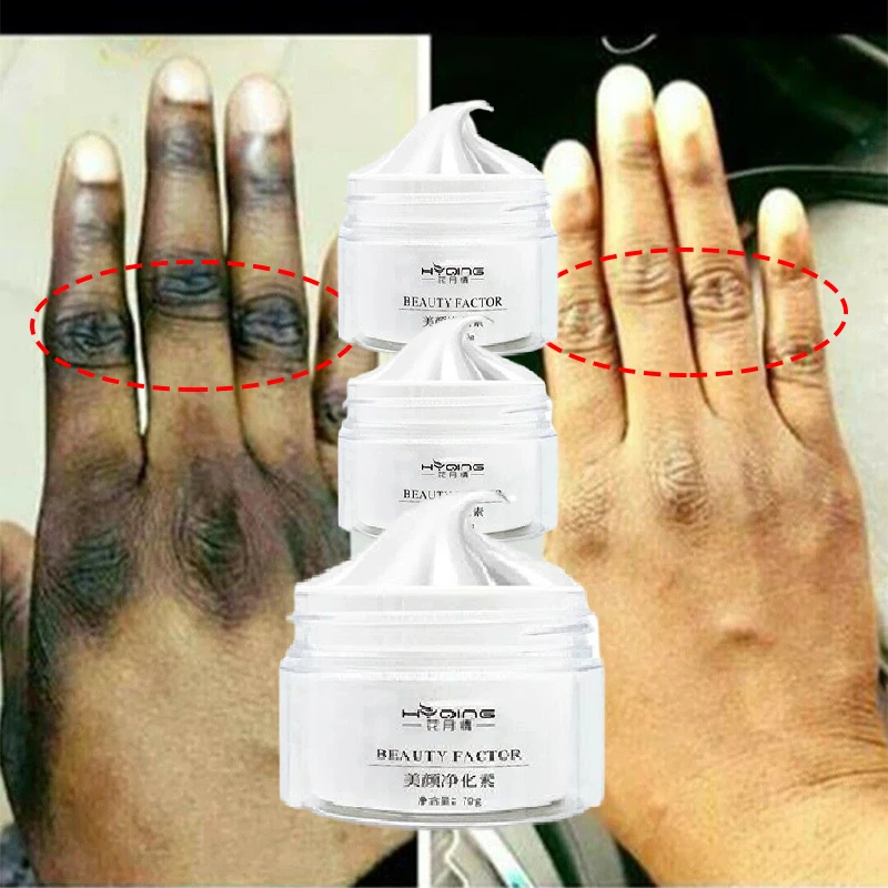 Whitening Cream Black Joints Underarm Knees Ankles Brightening Lightening Skin Body Lotion Skin Glow Bleaching Serum 70g
Whitening Cream Black Joints Underarm Knees Ankles Brightening Lightening Skin Body Lotion Skin Glow Bleaching Serum 70g