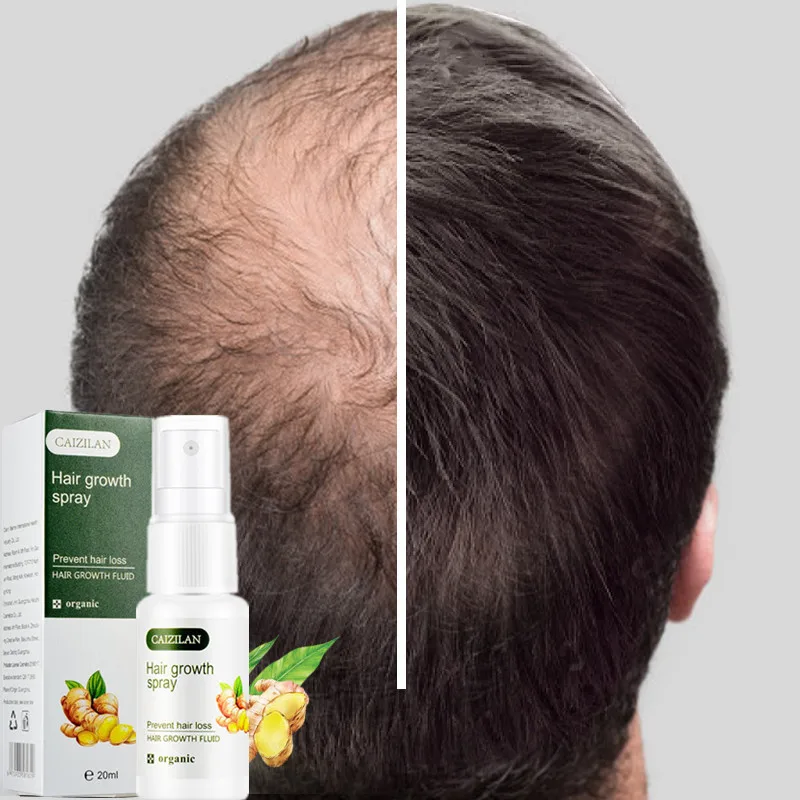 20ml Hot sale Ginger Fast Hair Growth Essence Oil Hair Loss Treatment Help for hair Growth Hair Care
20ml Hot sale Ginger Fast Hair Growth Essence Oil Hair Loss Treatment Help for hair Growth Hair Care