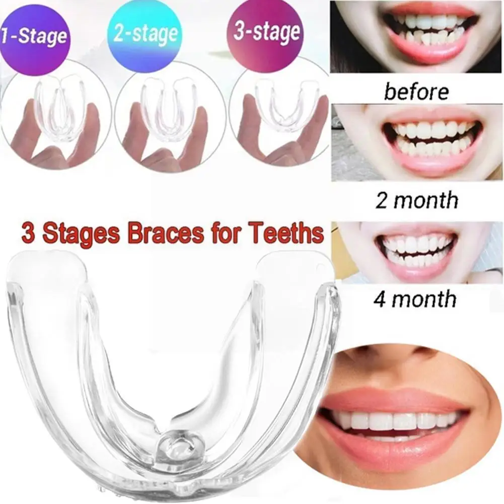 

Ортодонтические зубные скобы, зубные скобы, улыбка, выравнивание зубов, тренажер для зубов, силиконовые скобы для рта, защитный поддон, Instan ...