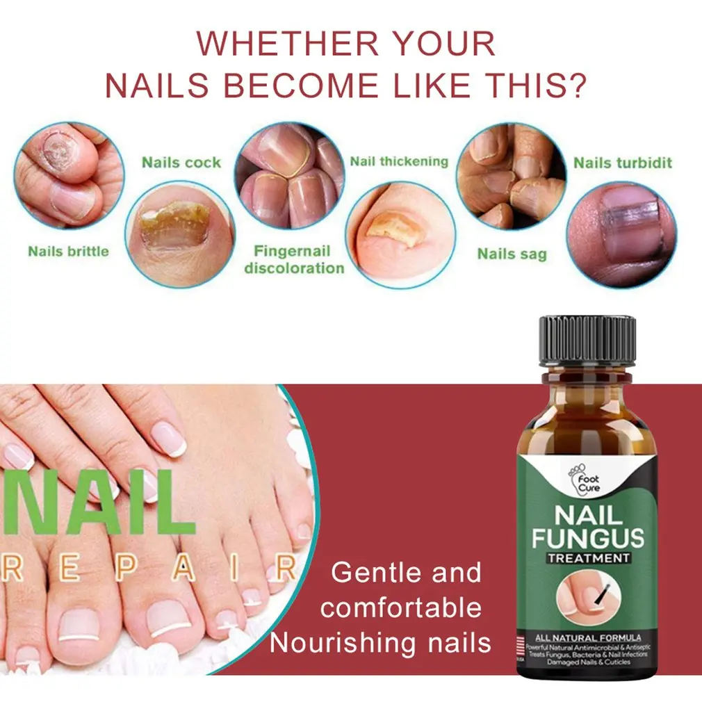 Nail Repair Solution Repair And Nourish The Nail Remove Onychomycosis Gentle And Comfortable Repair Solution
Nail Repair Solution Repair And Nourish The Nail Remove Onychomycosis Gentle And Comfortable Repair Solution