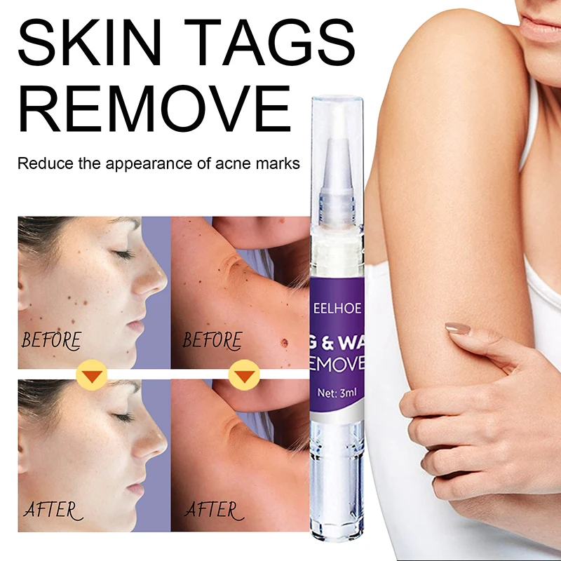 3ml Genital Wart Treatment Papillomas Removal Of Warts Liquid From Skin Tags Removing Against Moles Remover Anti Verruca Remedy
3ml Genital Wart Treatment Papillomas Removal Of Warts Liquid From Skin Tags Removing Against Moles Remover Anti Verruca Remedy